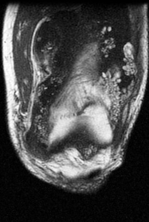 Figure 3 for case Lipoma arborescens